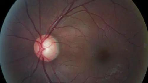 青光眼的克星来袭，助力患者远离视力的“窃贼”