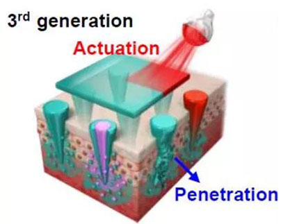 第三代：通过微针介导的皮肤层破坏和微针伴随的各种功能增强药物转运.jpg